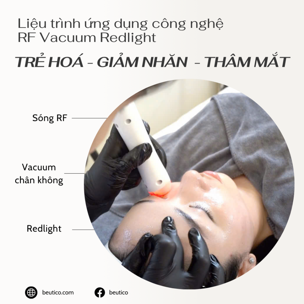 cong-nghe-rf-giam-nhan-quang-tham-mat-beutico